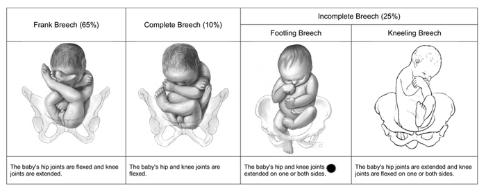 what are the types of breech presentation